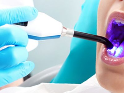 Imagen de láser en odontología